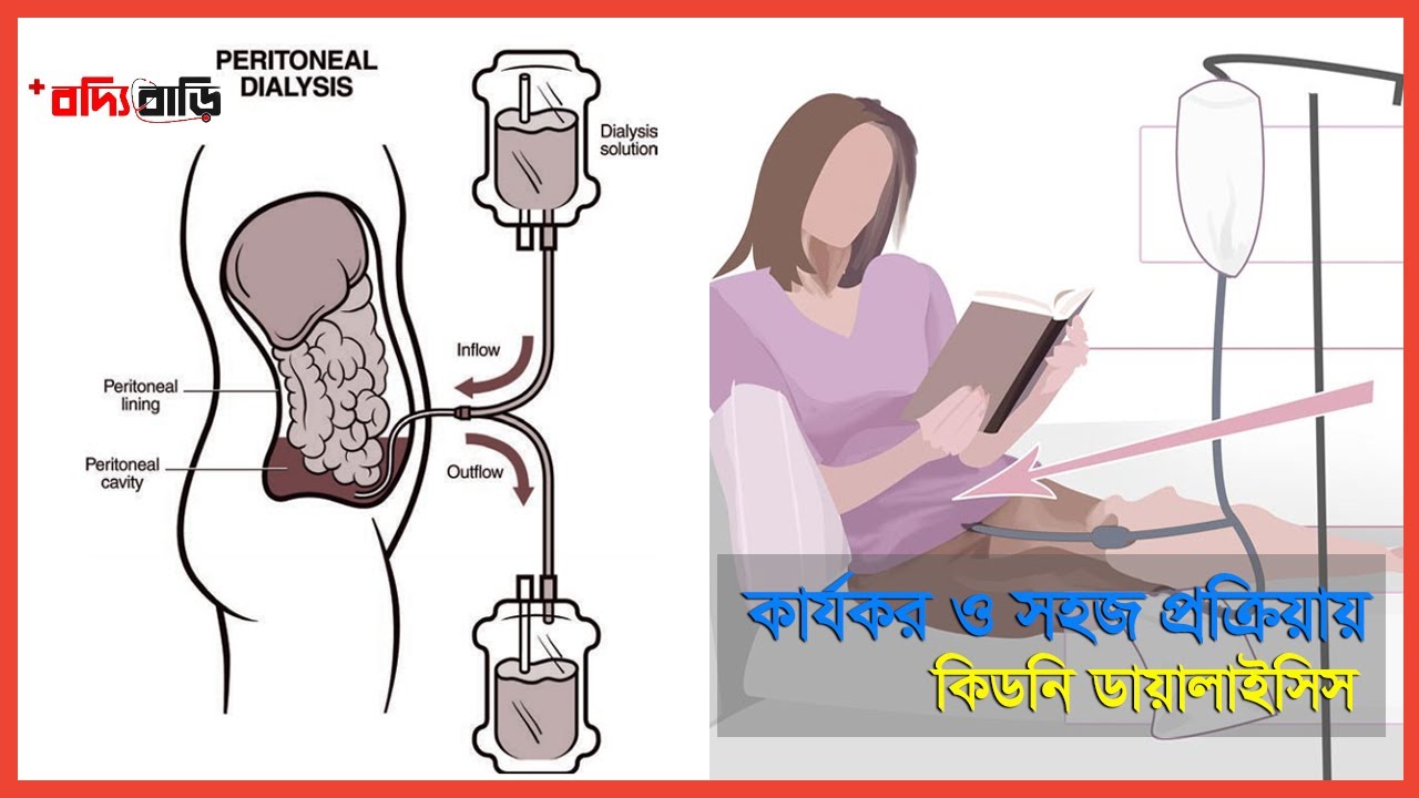 সিএপিডি; ঘরে বসেই কিডনি ডায়ালাইসিস | বদ্যি বাড়ি | Peritoneal dialysis | CAPD | Boddi Bari