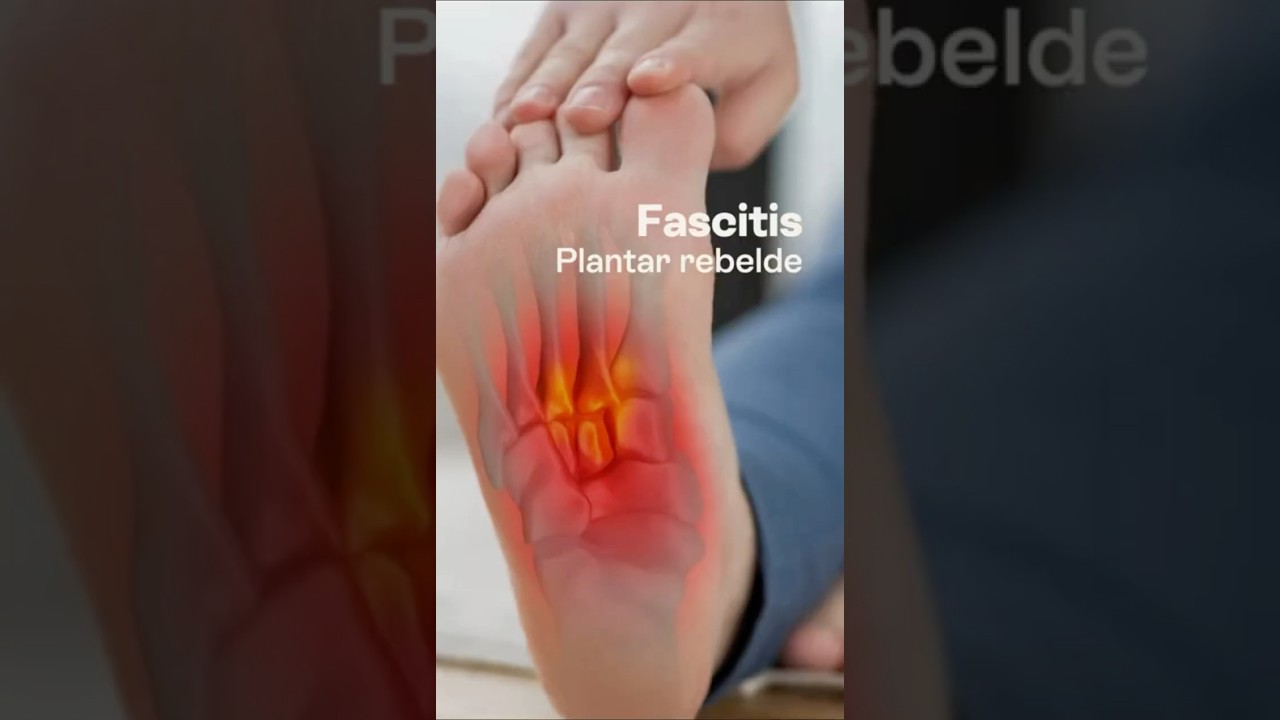 FASCITIS PLANTAR REBELDE