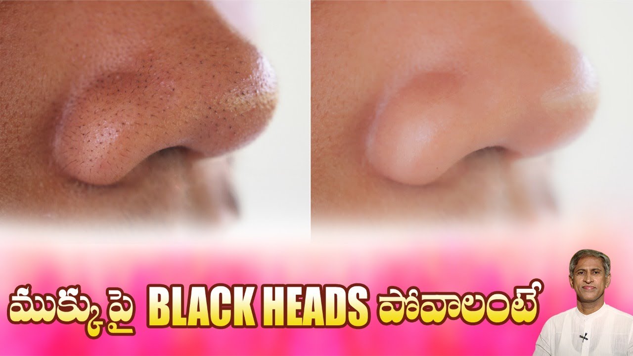 Magical Remedy to Remove Black Heads from Nose | Get Smooth Skin at Home | Dr.Manthena's Beauty Tips