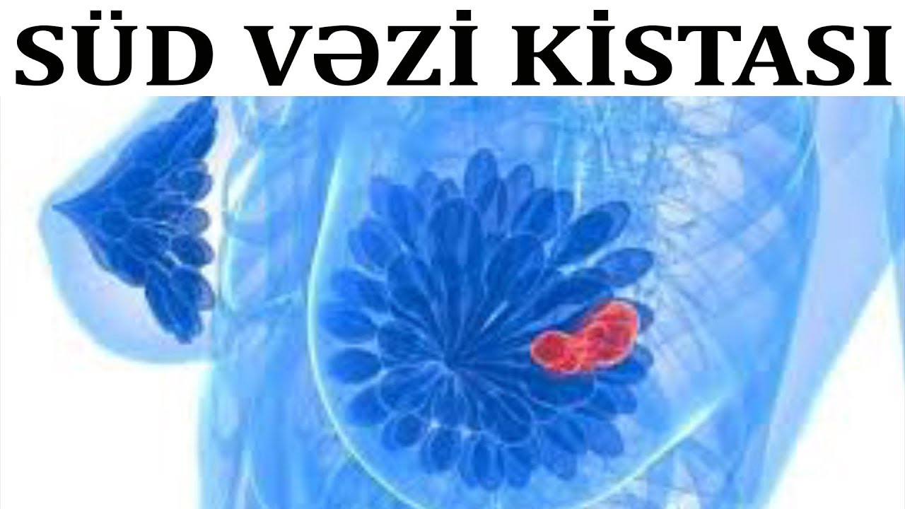 Süd vəzi kistası xərçəngə çevrilə bilərmi?