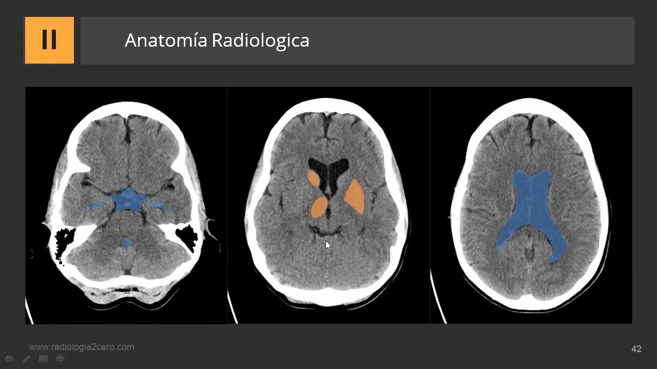Cómo describir una TC de Cerebro
