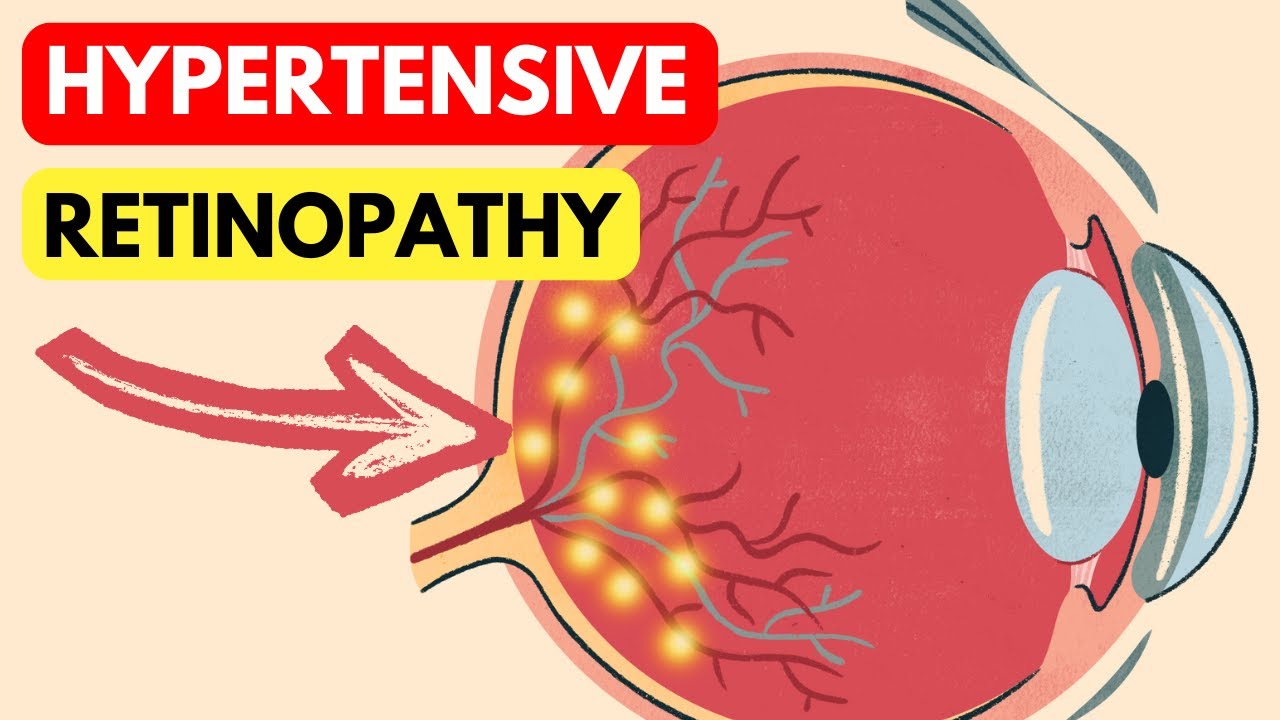 What does Hypertension do to Your Eyes?