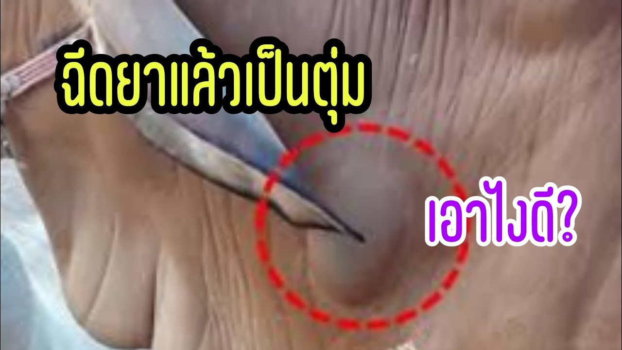 เป็นตุ่มบวมแบบนี้แก้ได้