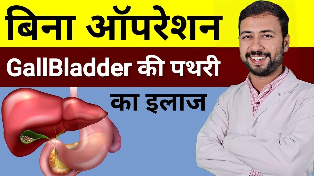 बिना ऑपरेशन GallBladder की पथरी का इलाज | gallbladder stone removal without removing gallbladder