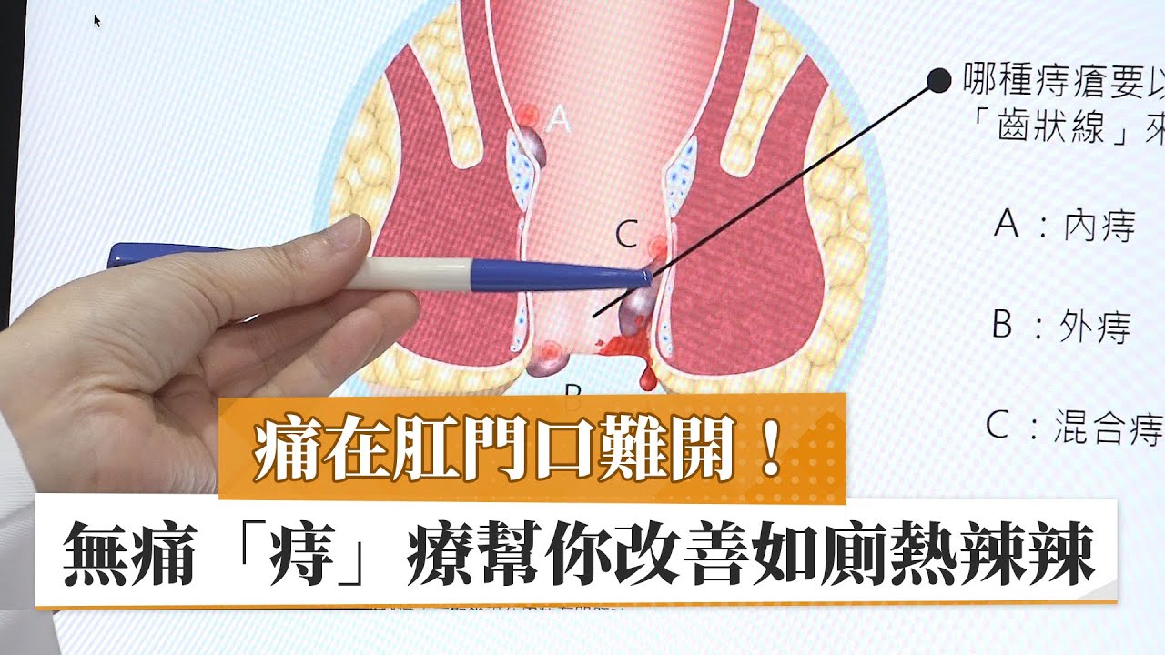 【痔瘡】痛在肛門口難開！　無痛「痔」療幫你改善如廁熱辣辣｜健康醫療網