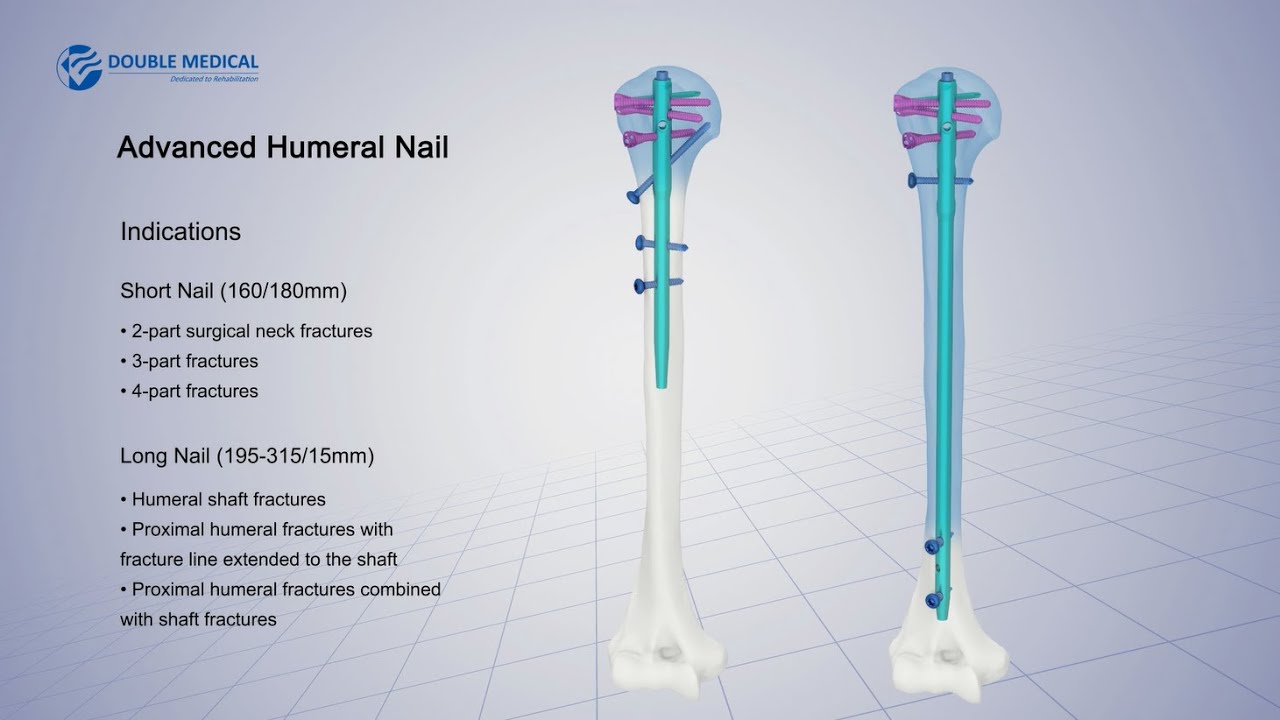 Double Medical Advanced Humeral Nail ( AHN )