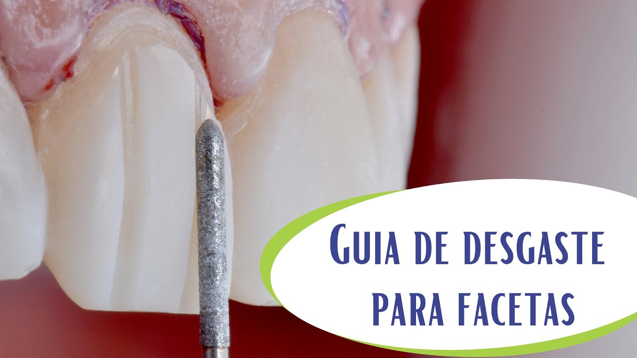 Guia de desgaste para preparo de facetas.