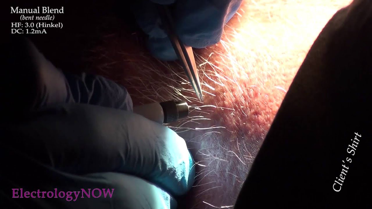 Treating White Hairs