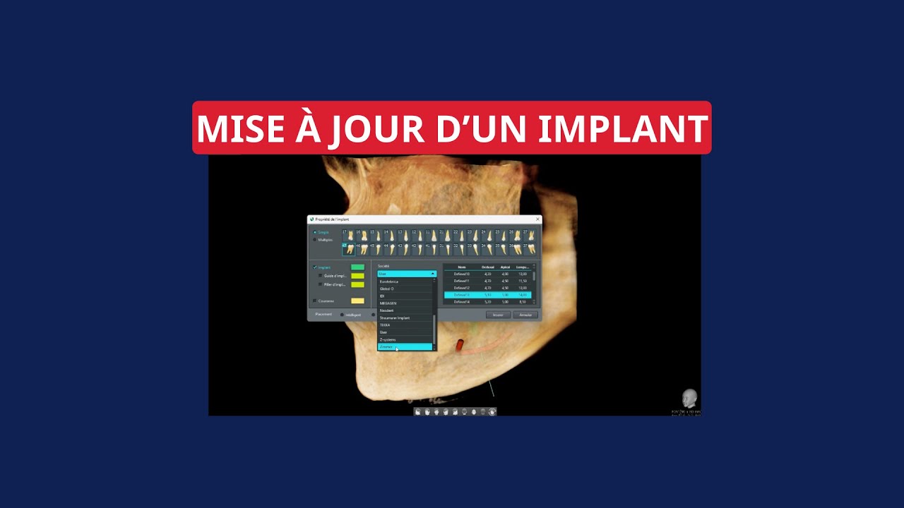 [Vatech Care] Mise à jour d'un implant