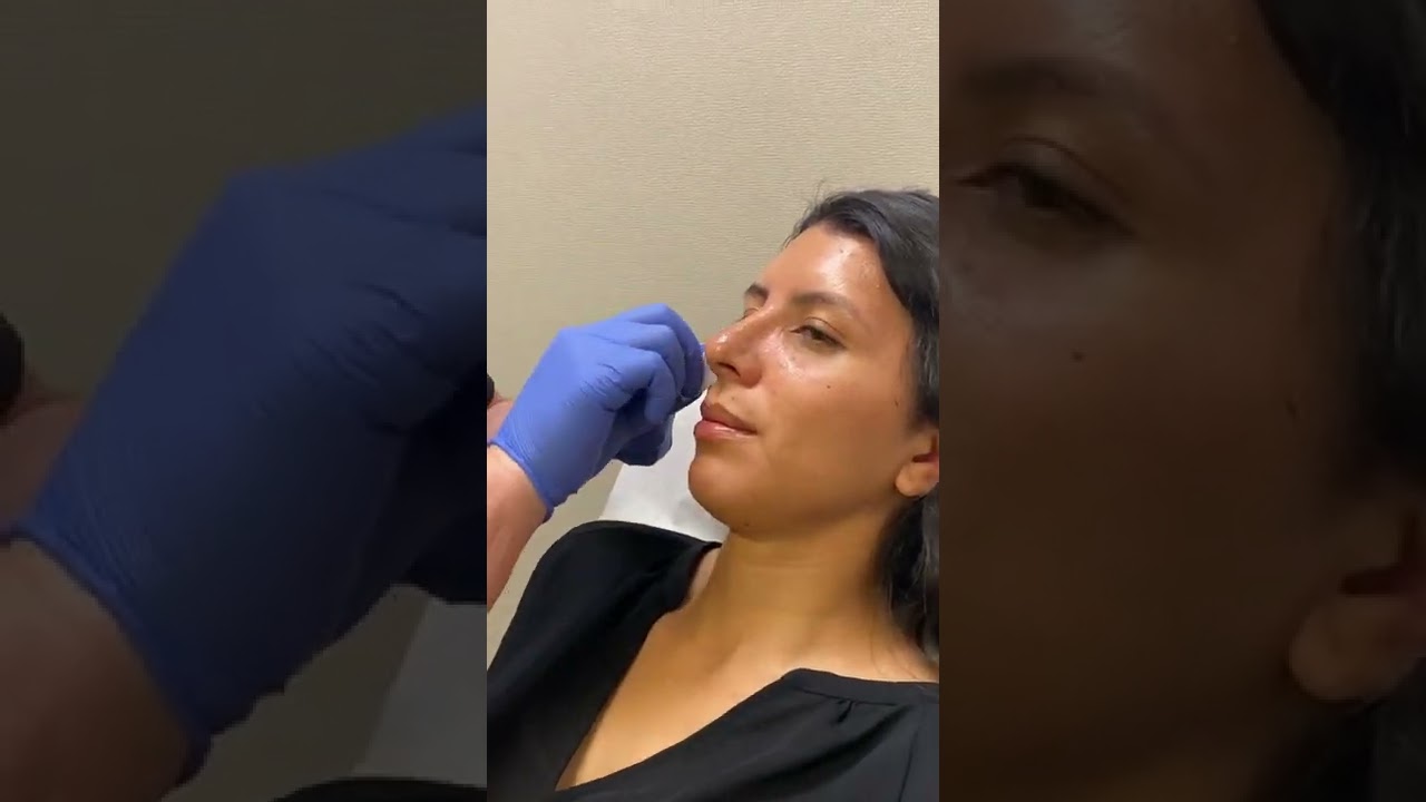 Rhinoplasty Reveal