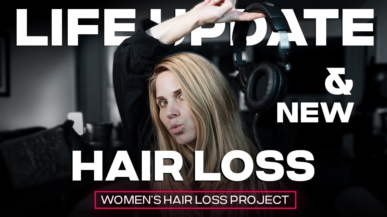 Life Update and a New Hair Loss - Diffuse Alopecia Areata (Incognita)