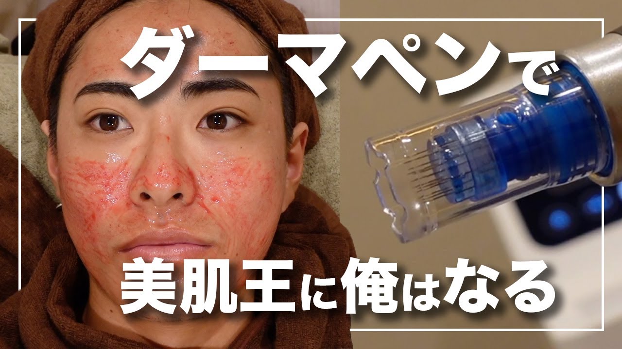 【ニキビ跡 毛穴改善】ダーマペンで肌再生してモテ肌へ。