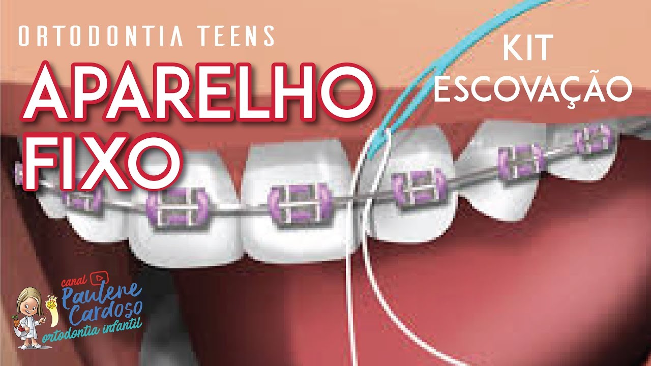 Dra Paulene Cardoso - Como fazer a limpeza de seu aparelho fixo