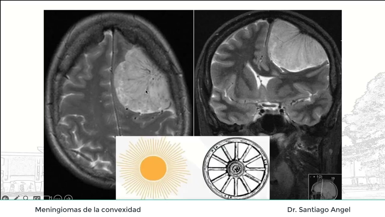 Meningiomas de la convexidad