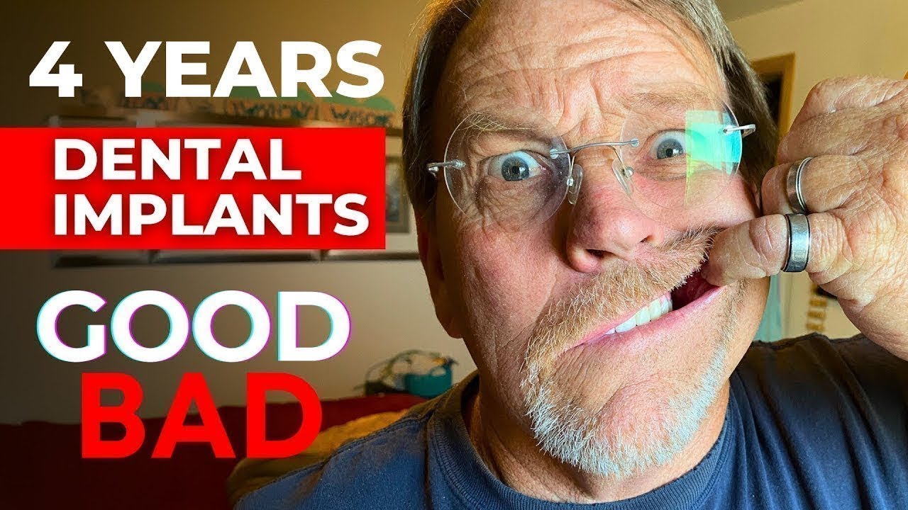 My Review of Full Dental Implants After 4 Years