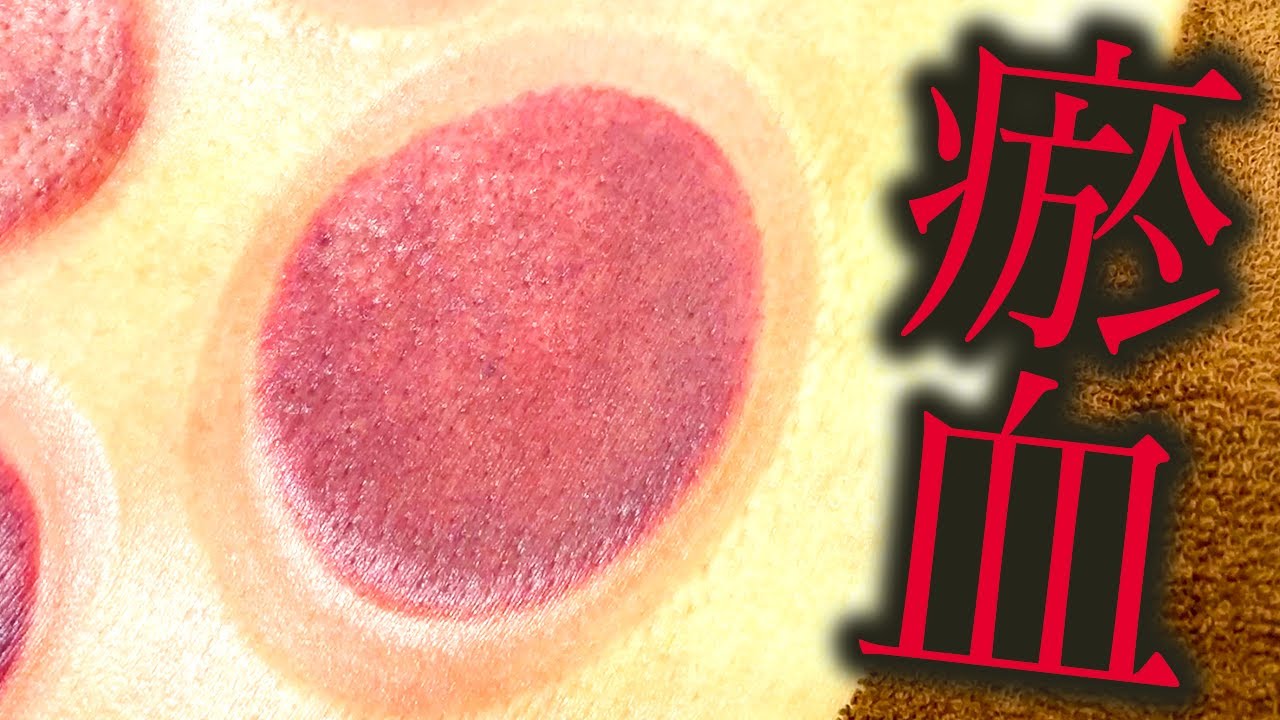 【カッピング 効果】カッピングは効果ある？疲労の患者さんにカッピングしたら瘀血が…