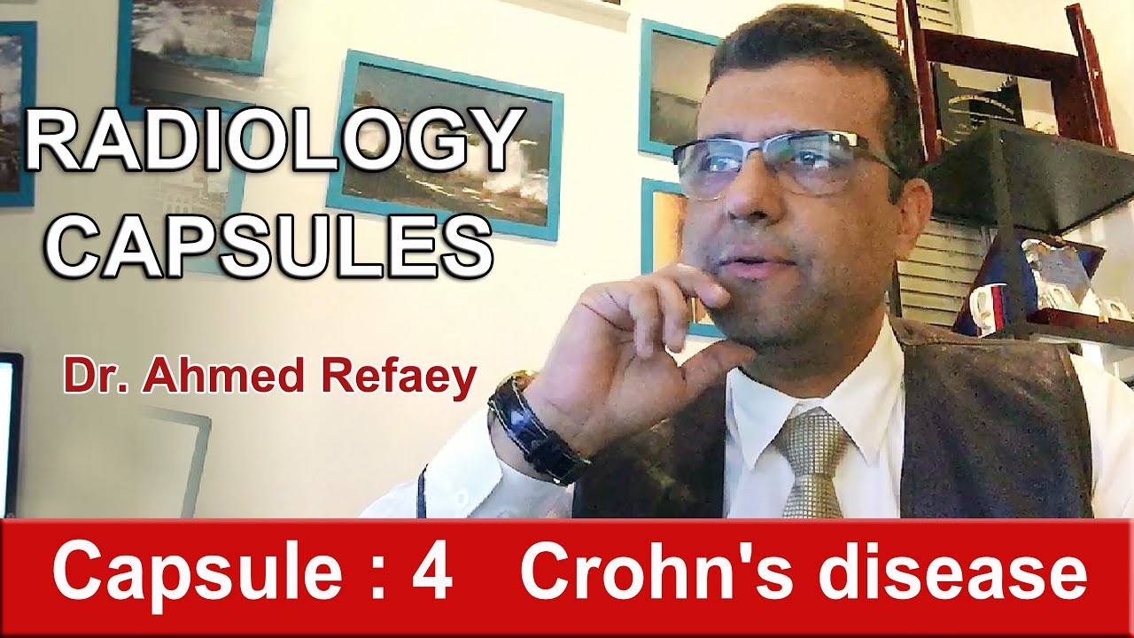 Capsule : 4 - Crohn's disease