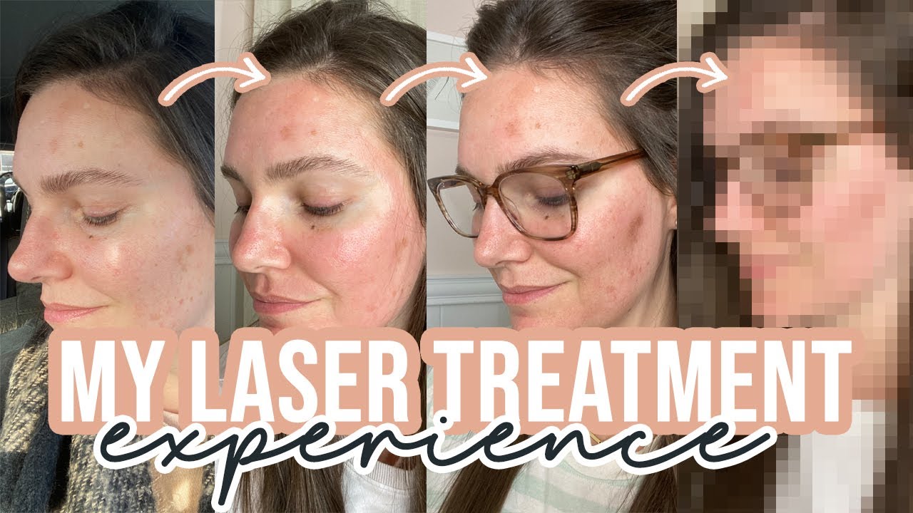 LaseMD Laser Treatment Before & After | Fixing My Skin | Sarah Brithinee