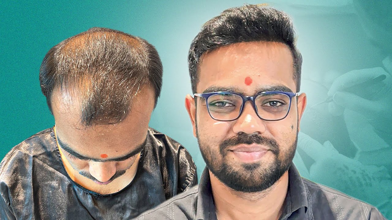 He Started With Grade 5 Baldness… Look at His Hair After 5 Months 😍 | Kolhapur | New Roots