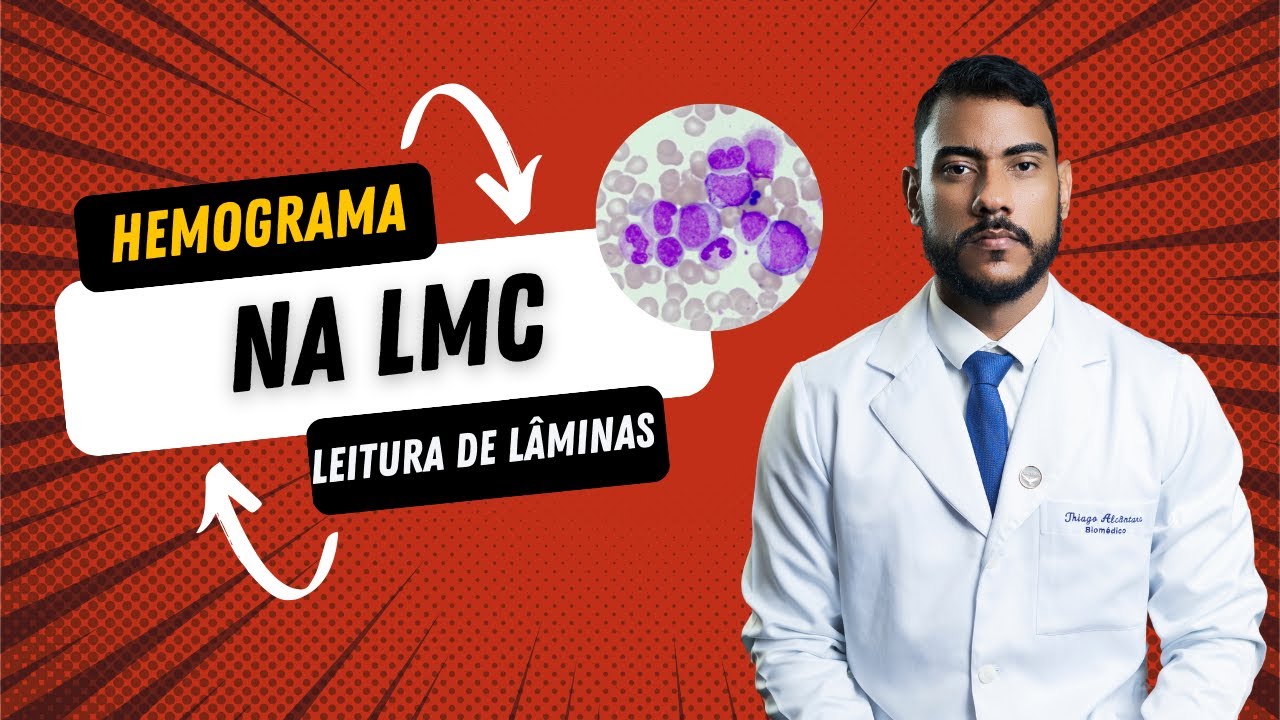 Hemograma Na Leucemia Mieloide Crônica ( LMC)