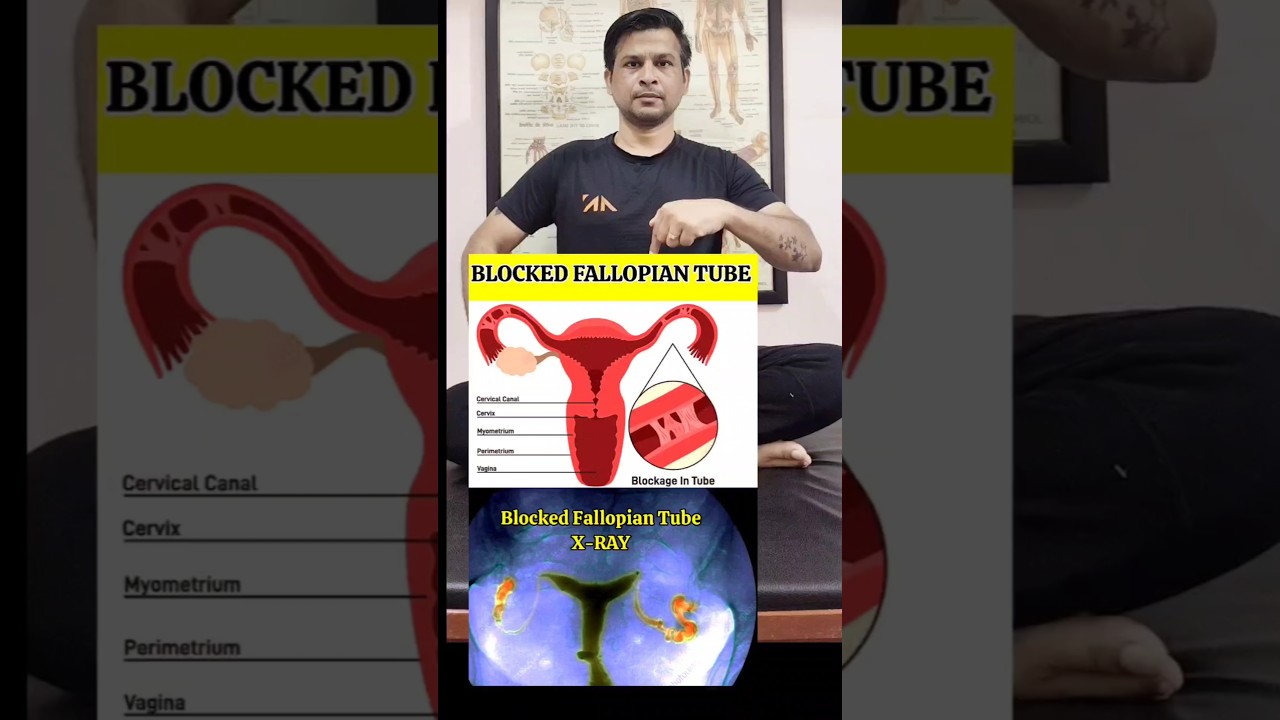 Best Exercise for Blocked Fallopian Tube #shorts #tranding
