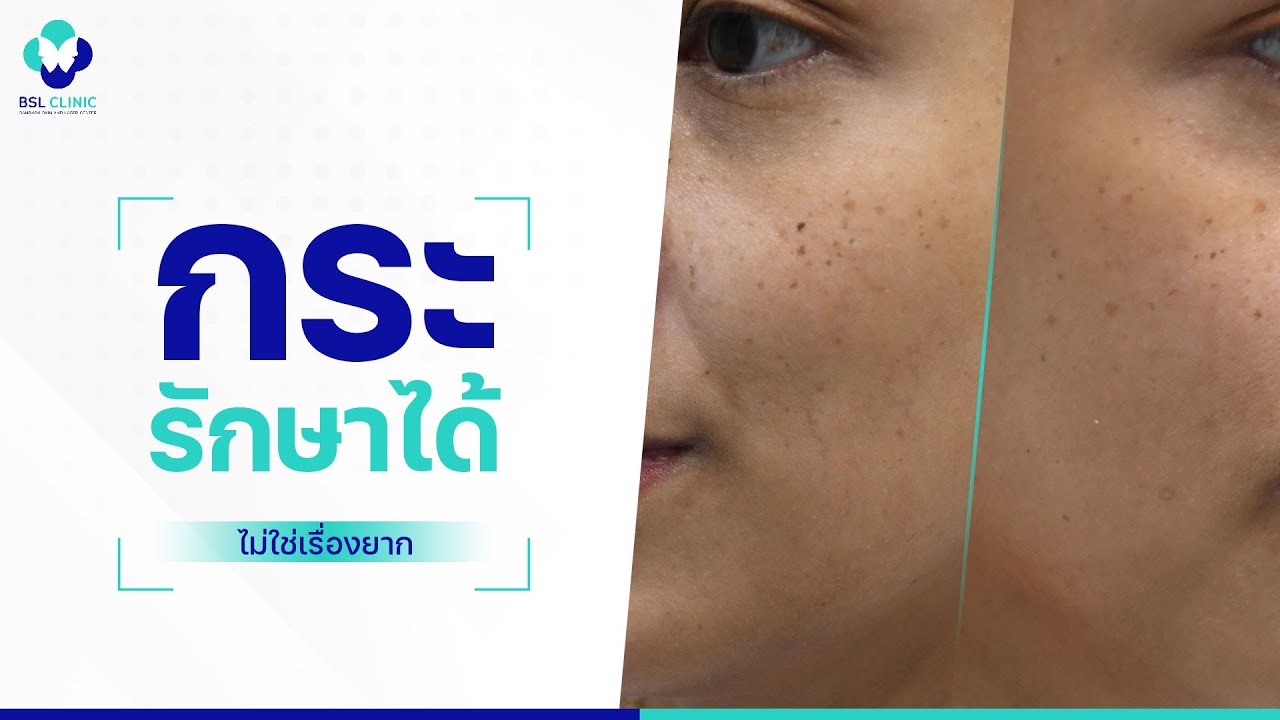 รักษากระ | EP.17 | หน้าเป็น &ldquo;กระ&rdquo; รักษากระ ให้จางลงได้ หน้าใสขึ้น | BSL Clinic