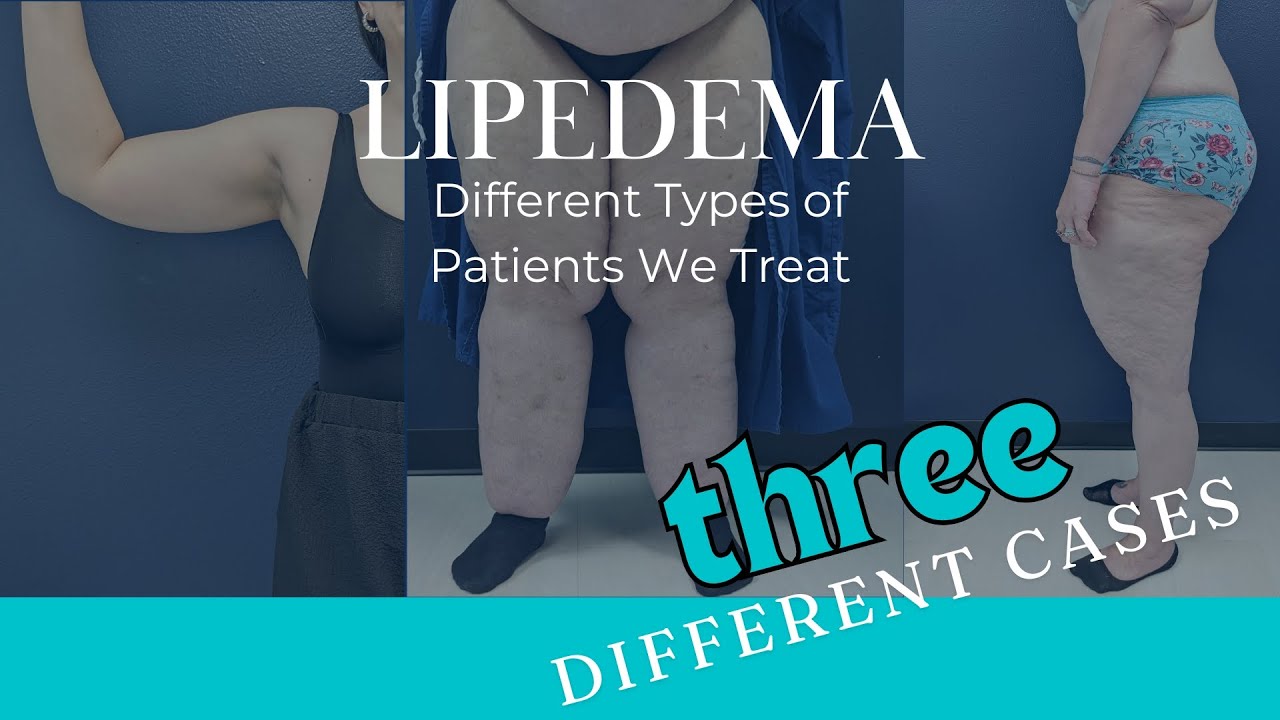 Deciding Lipedema Treatment | How To Choose
