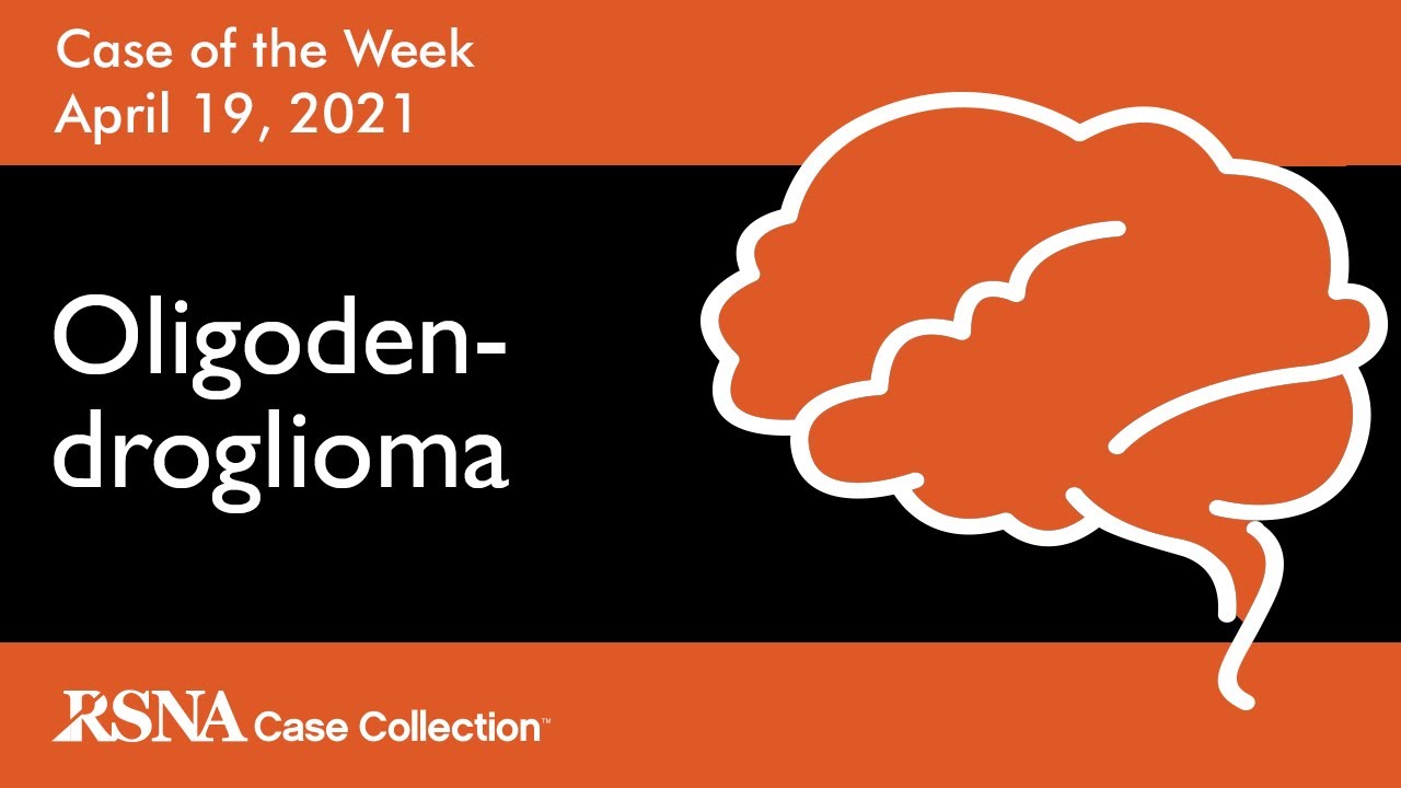 Case of the Week: Oligodendroglioma