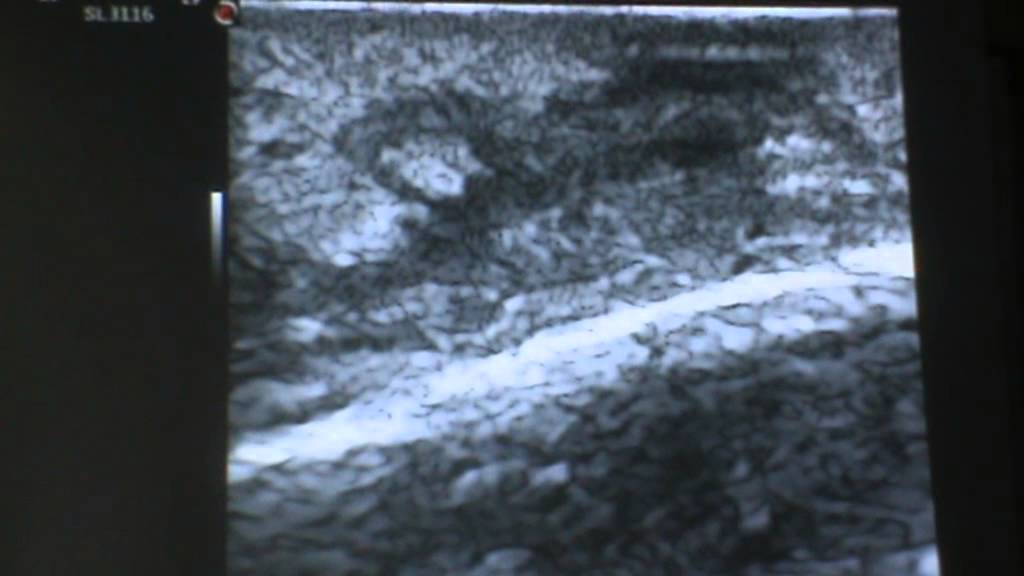 CURSO DE ECOGRAFIA CUTANEA BASICA PARA DERMATOLOGOS