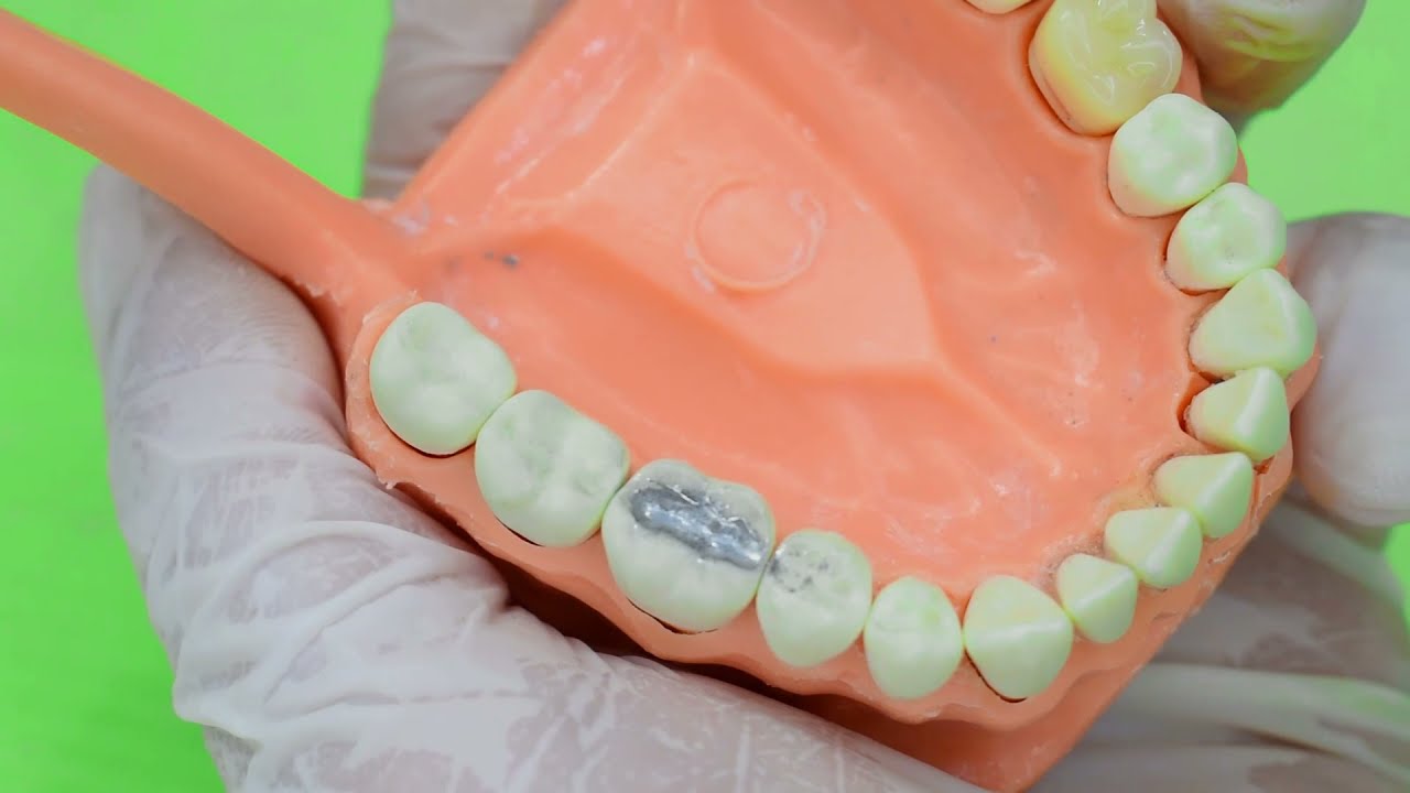 ¿Cómo poner una Amalgama Dental?