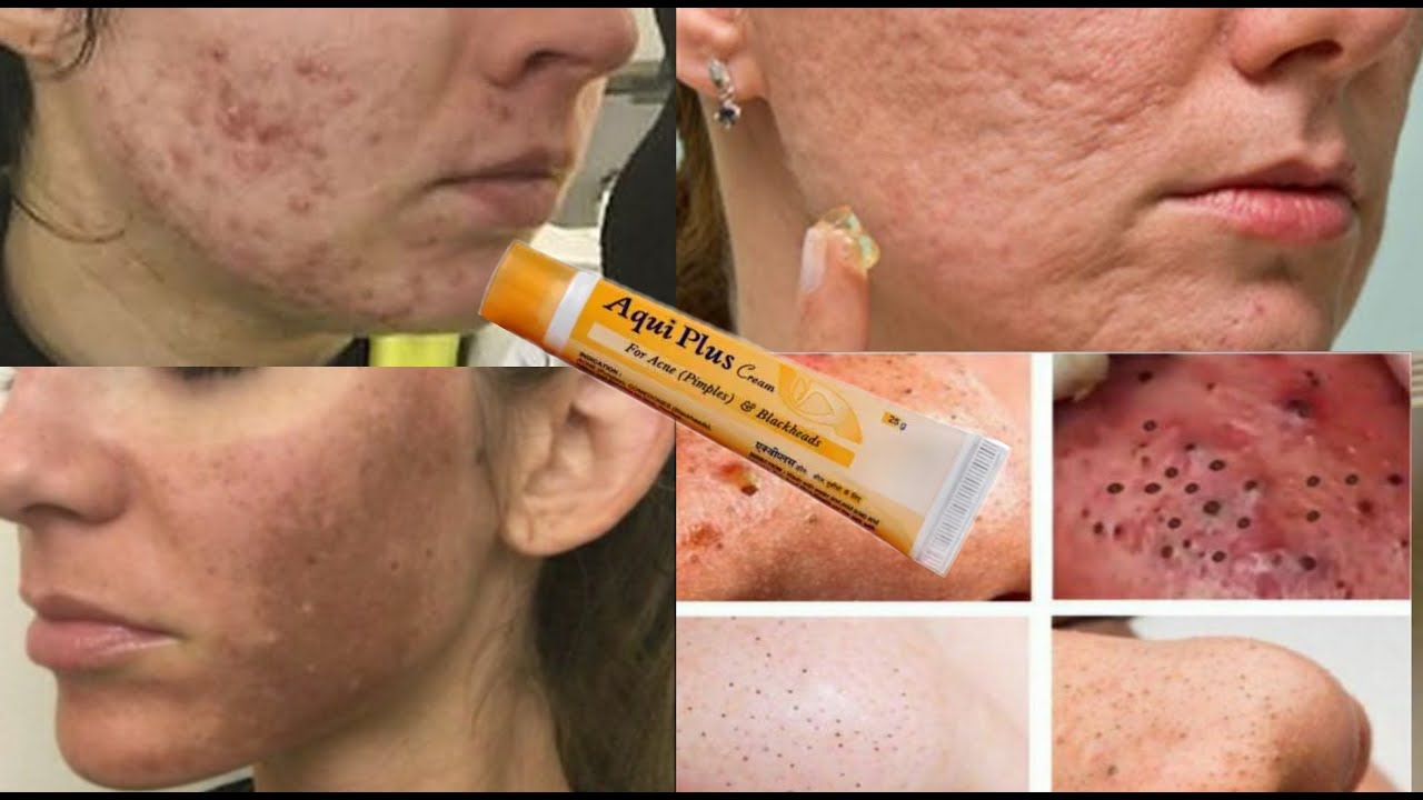 Aqui Plus Best Homeopathy Cream Remove Acne |Pimples|Blackheads |Dark Spots|Pigmentation