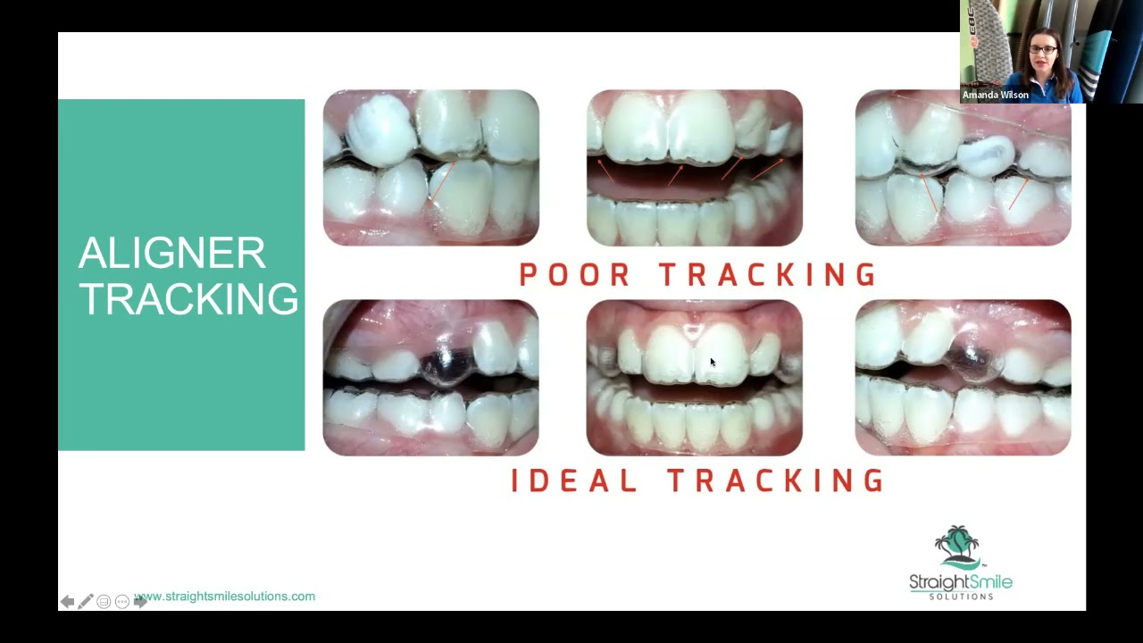 Posterior Open Bite and Aligners