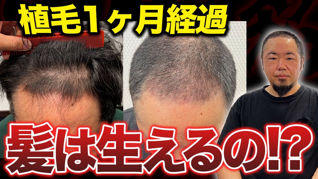 【植毛1ヶ月経過】27年薄毛に悩んできた男性の髪の毛はどこまで増えた？