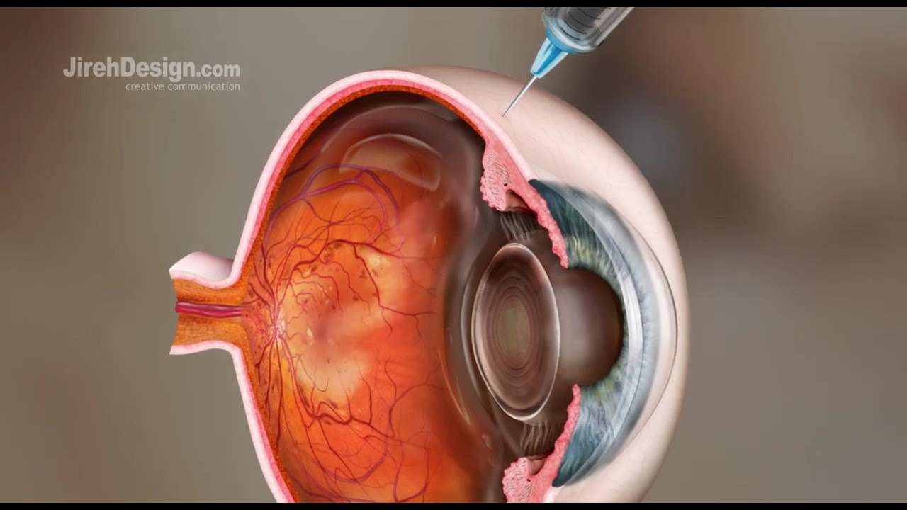 Intravitreal Injection Animation [HD]