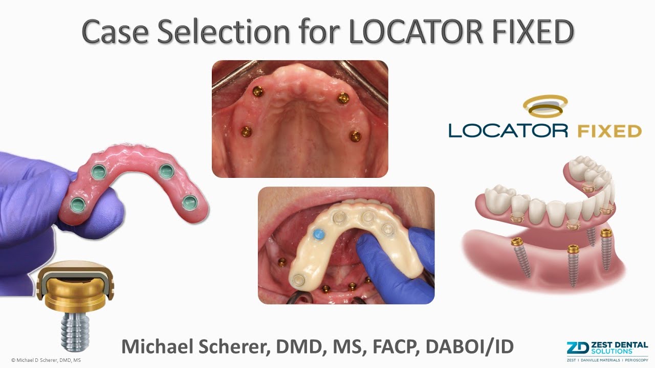 Case Selection for LOCATOR FIXED - Finding Your First Case ... and Working up to Advanced Cases!!