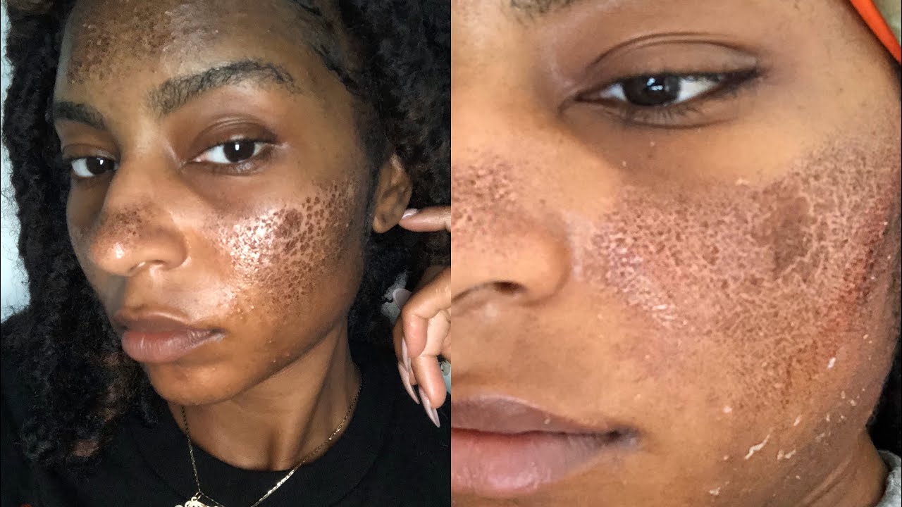 How I Ruined my skin! Burned + Scarring & Hyperpigmentation | Fraxel| iamLindaElaine