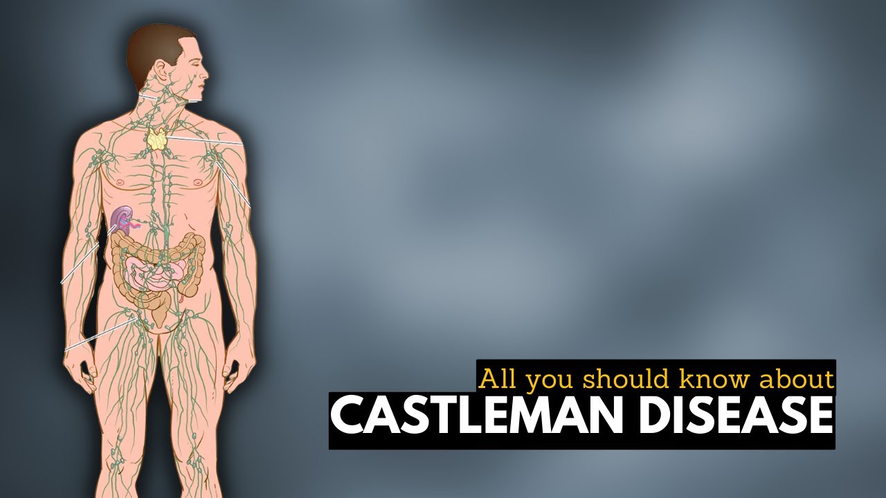 Castleman Disease: What You Need to Know