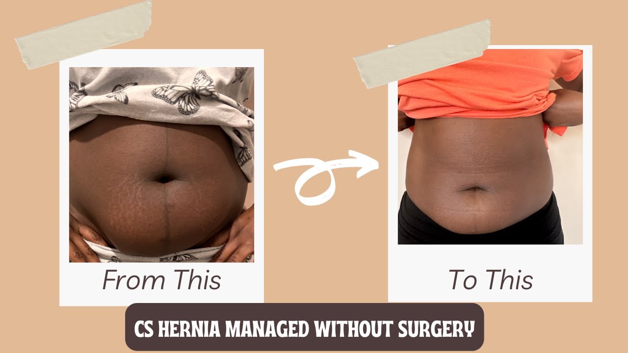 How I Managed My C-Section Hernia Without Surgery | Doctor’s Personal Tips & Advice