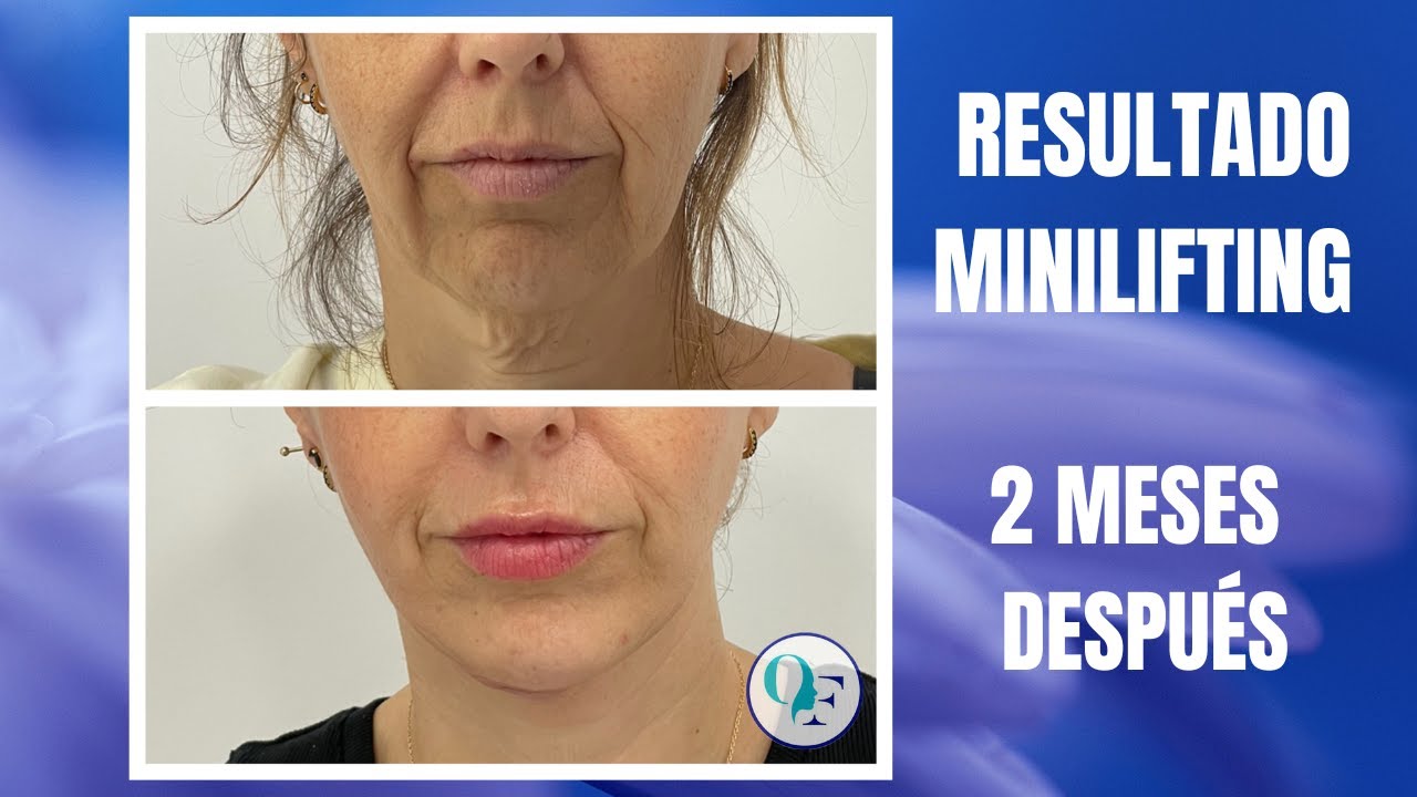 RESULTADO MINILIFTING