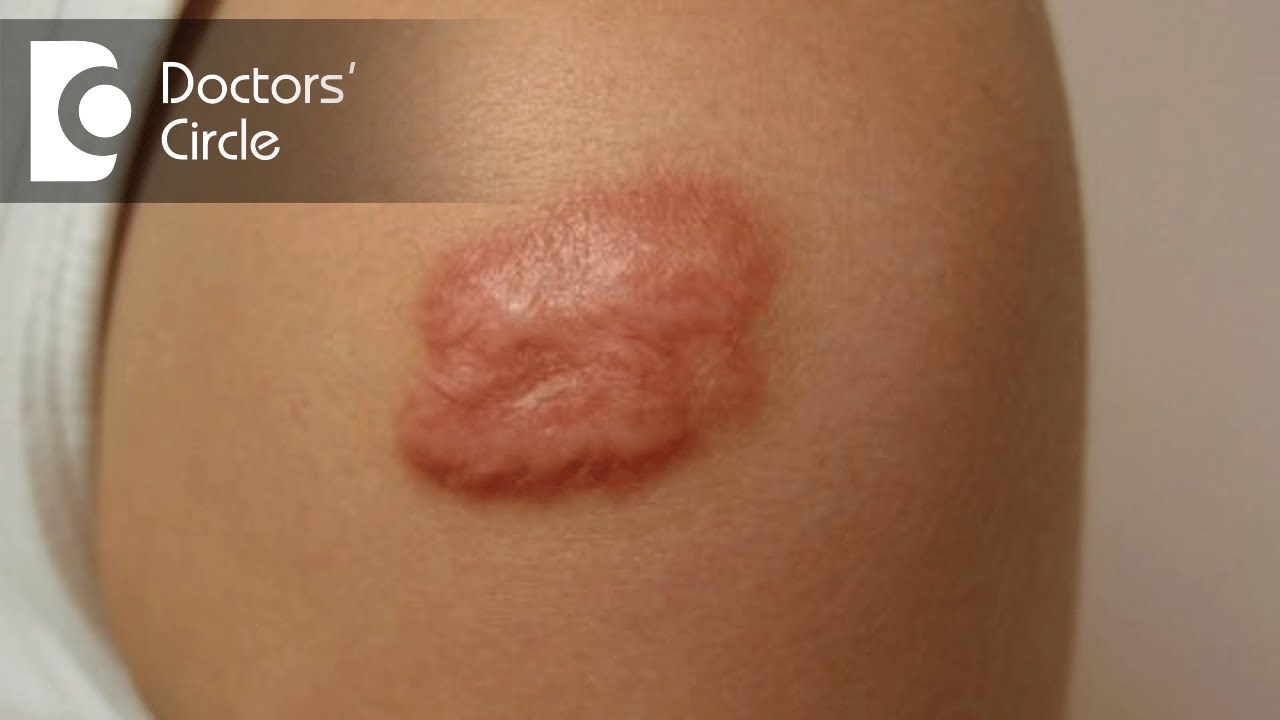 Can Lasers help patients with burn marks? - Dr. Pavan Murdeshwar