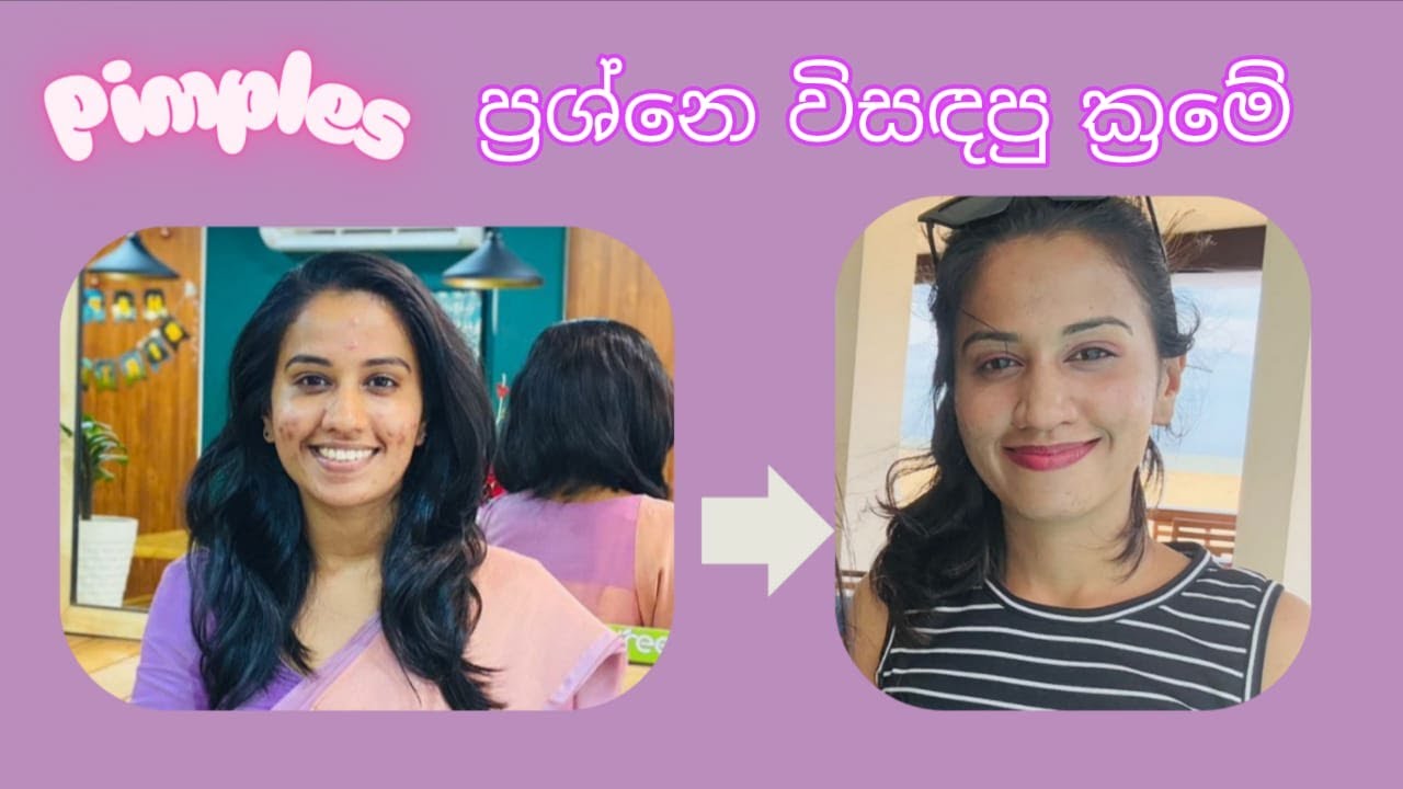 Pimples ප්‍රශ්නෙ විසඳපු ක්‍රමේ🥰