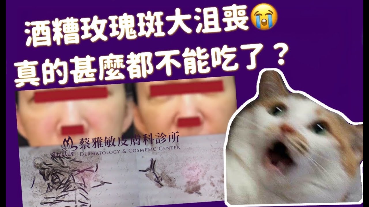 006集-有酒糟玫瑰斑大沮喪，到底有甚麼食物地雷該注意?