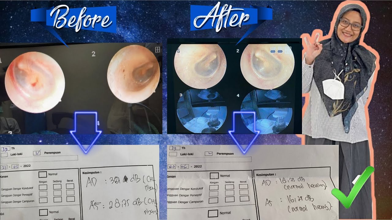 PENDENGARAN KEMBALI NORMAL, ASI MELIMPAH || #hearingloss #boosterasi #autoimmunedisease #hyperbaric