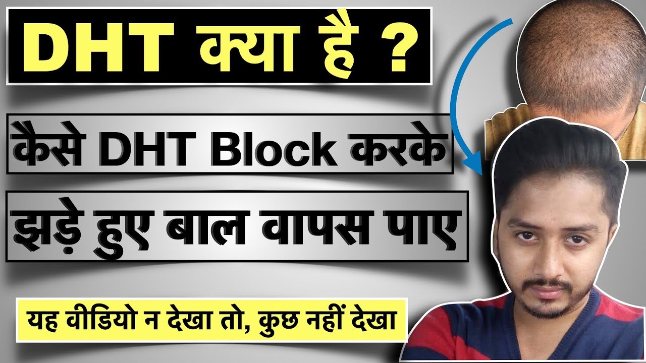 DHT क्या है और कैसे इसको block करके , झड़े बाल वापस पायें ? How to Block DHT to regrow Hair?