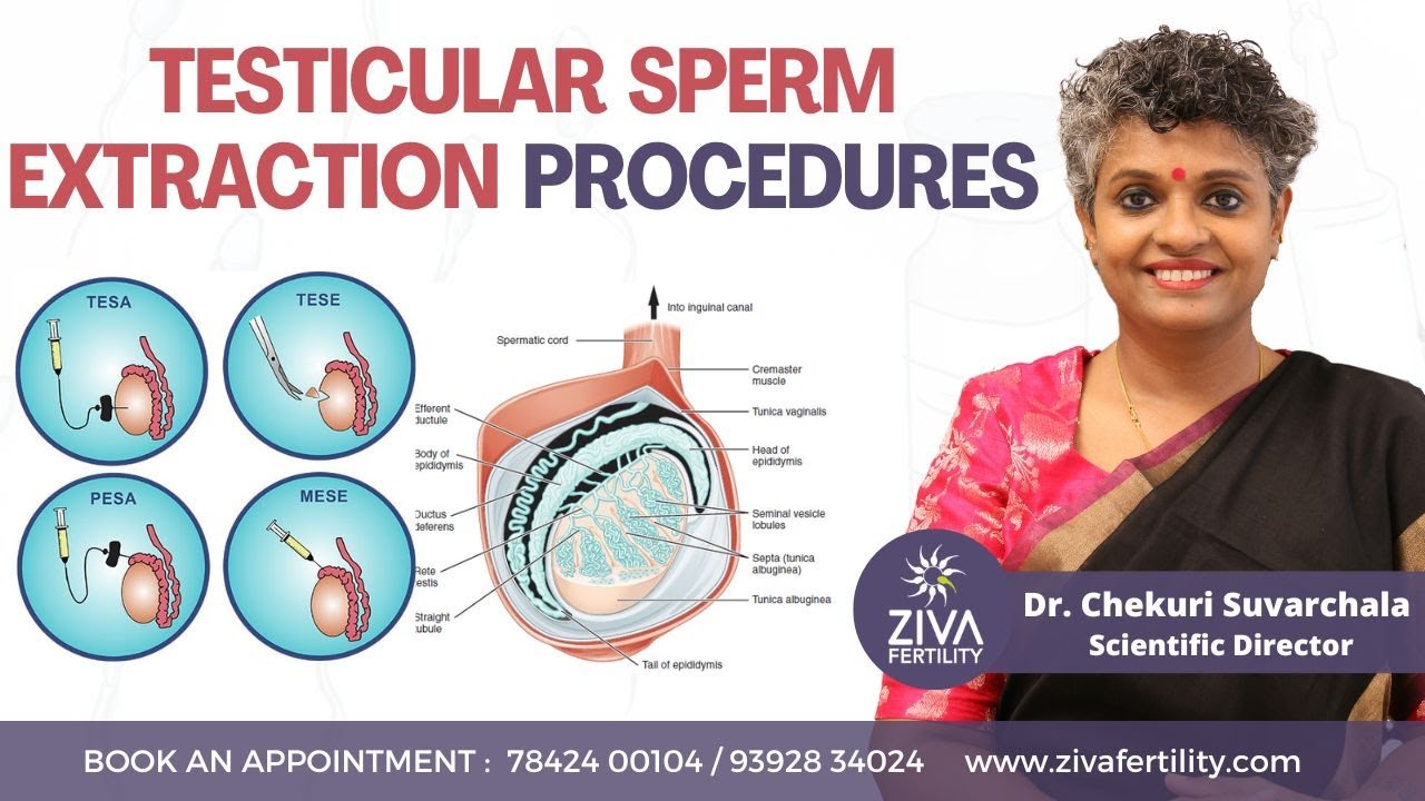 Testicular Sperm Extraction Procedures || Male Fertility || Dr Chekuri Suvarchala || ZIVA Fertility