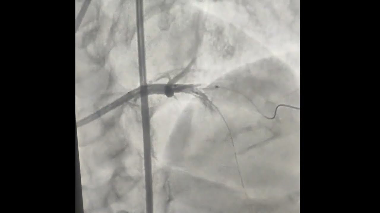 Modified Mini Crush Bifurcation Stenting
