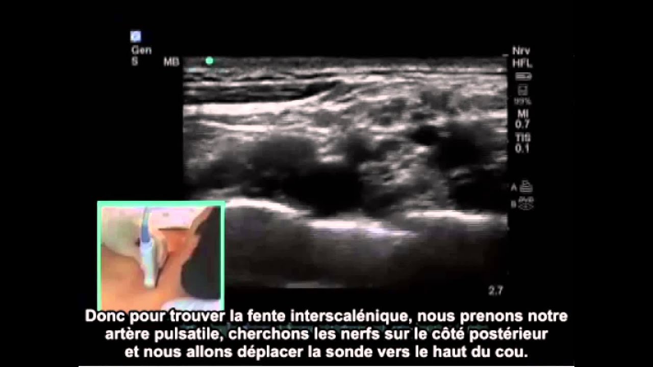 Réaliser un bloc nerveux interscalénique au niveau du plexus brachial par guidage échographique
