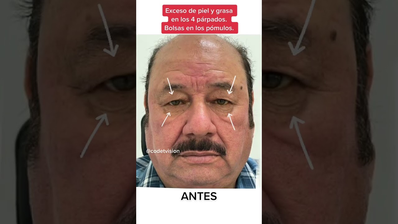 &iexcl;Resultados de cirug&iacute;a de p&aacute;rpados! #parpados #bleflaroplastia #cirugiaestetica #antesydespues