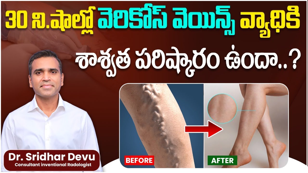 Causes of Varicose Veins | How to Get Rid of Varicose Veins | How to Treat Varicose Veins Easily