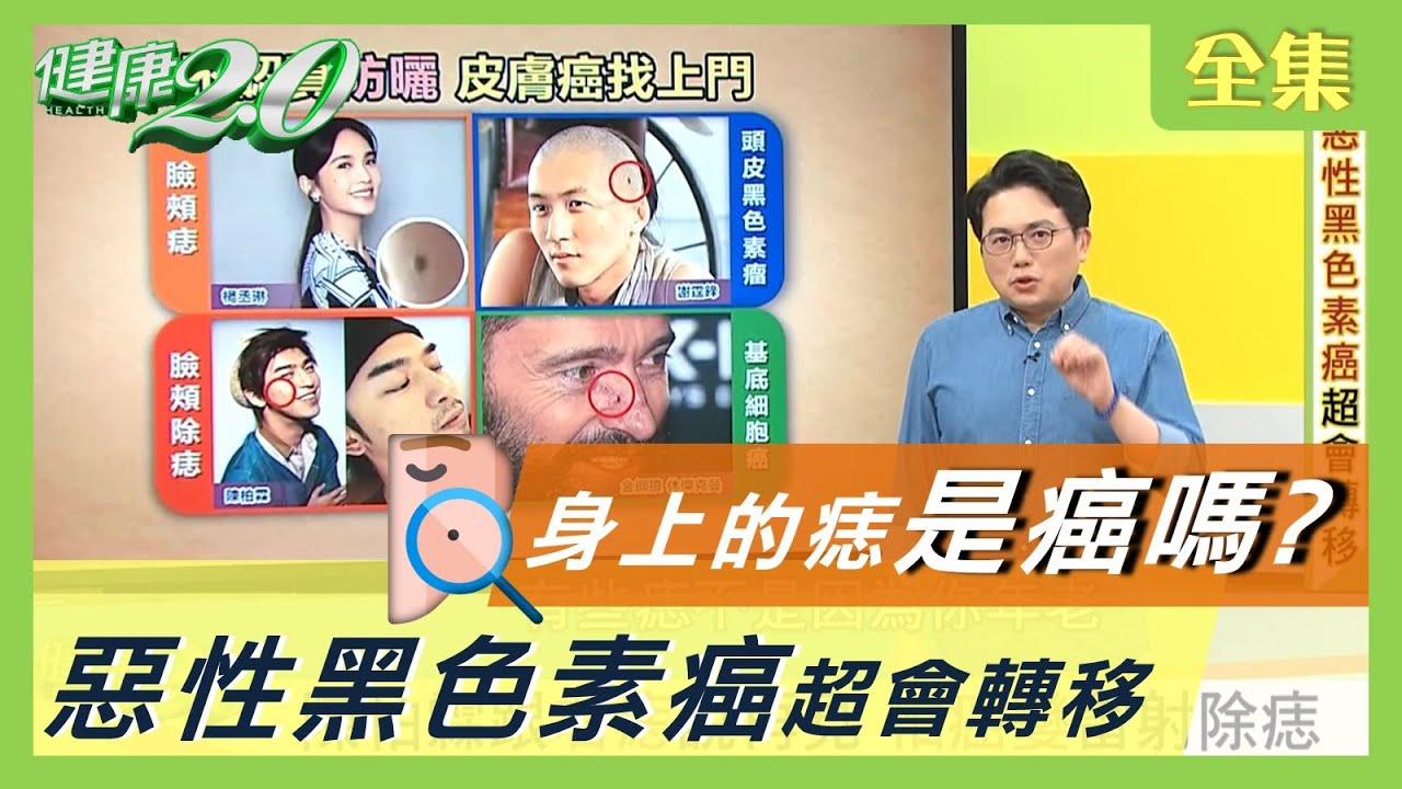 你身上的痣是癌嗎？ 惡性黑色素癌超會轉移 健康2.0 20200930 (完整版)